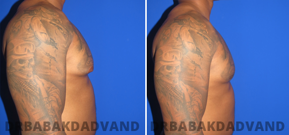 Before and After Photos. Gynecomastia. 4